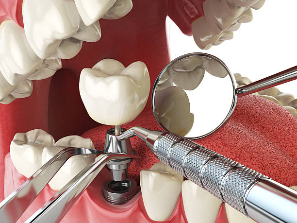Best Emergency Tooth Extraction in Gretna, VA